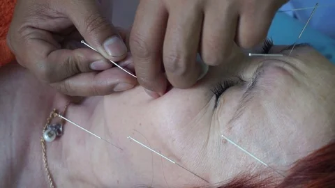 Acupuncture of the face. Stock Footage 81795940
