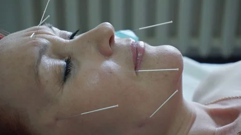 Acupuncture of the face. Stock Footage 81797128