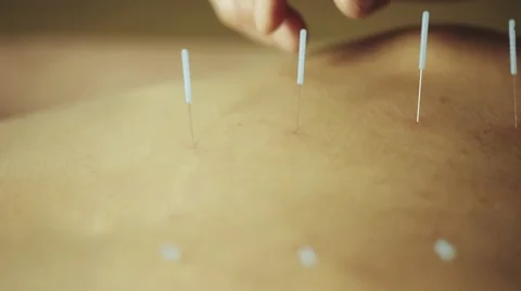 Acupuncture on female back Stock Footage