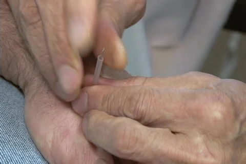 Acupuncture 動画素材 711234