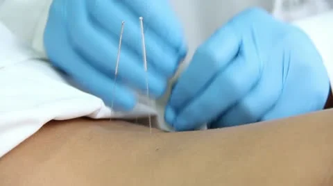 Acupuncture Stock Footage 22134816