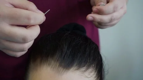 Acupuncture of the head. Stock Footage 81415369
