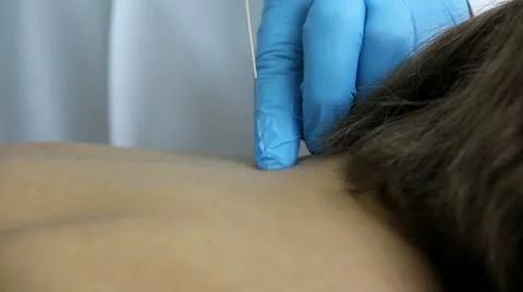 Acupuncture long Stock Footage 22132852