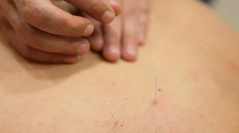Acupuncture medical procedure Stock Footage 36601032