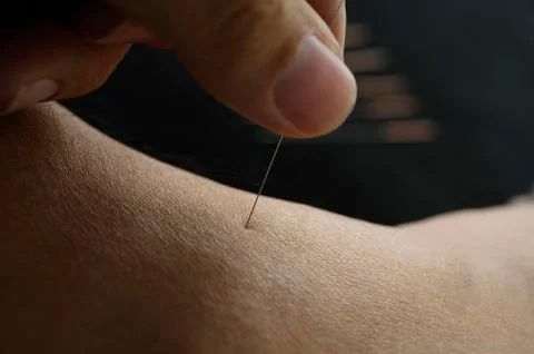 Acupuncture needle being inserted Stock Photos