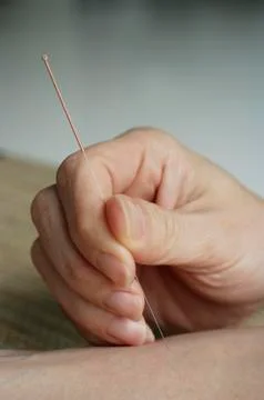 Acupuncture needle being inserted Stock Photos