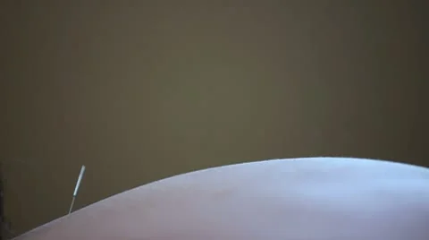 Acupuncture Needle Inserted in Back Stock Footage 8912611