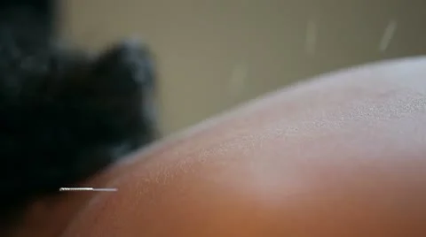 Acupuncture Needle Inserted Stock Footage 8912759