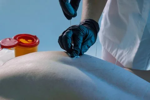 Acupuncture needle insertion on the back by clinician wearing gloves Stock Photos