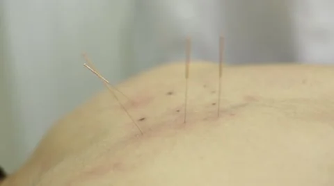 Acupuncture Needles Setting In Back Of Patient Video stock 62710935