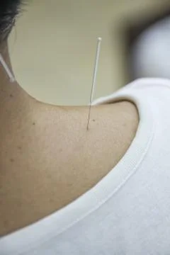 Acupuncture Stock Photos
