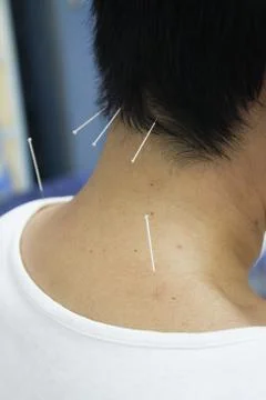 Acupuncture Stock Photos