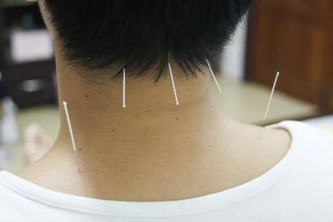 Acupuncture Stock Photos