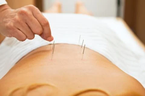 Acupuncture Foto stock