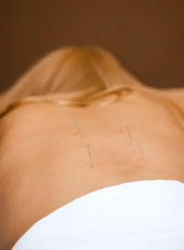 Acupuncture Stock Photos