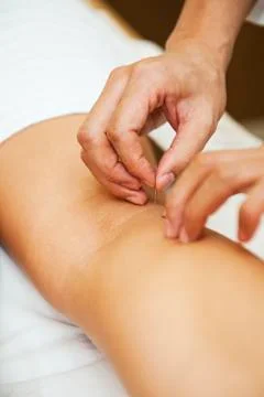 Acupuncture Stock Photos