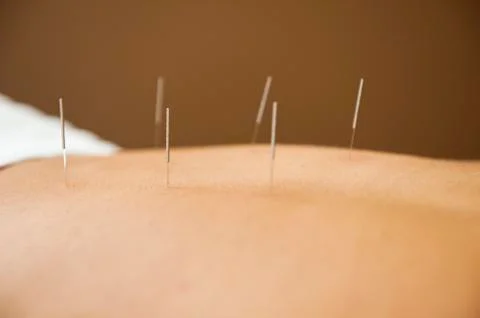 Acupuncture Stock Photos