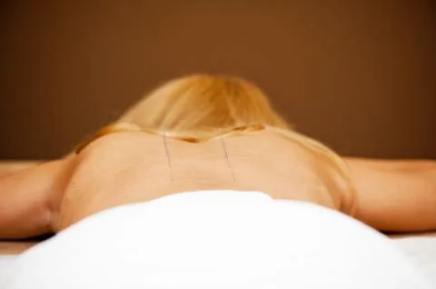 Acupuncture Stock Photos