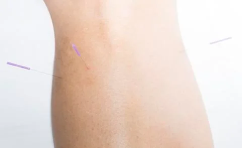 Acupuncture Stock Photos