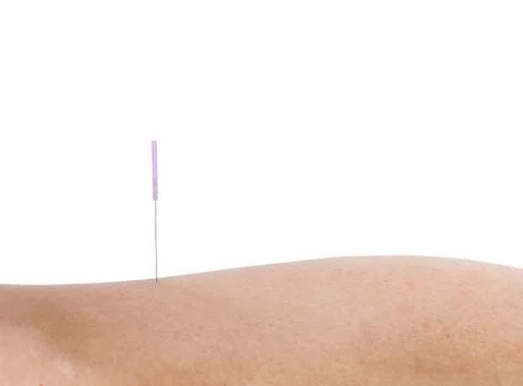 Acupuncture Stock Photos