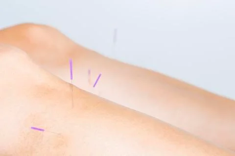 Acupuncture Stock Photos