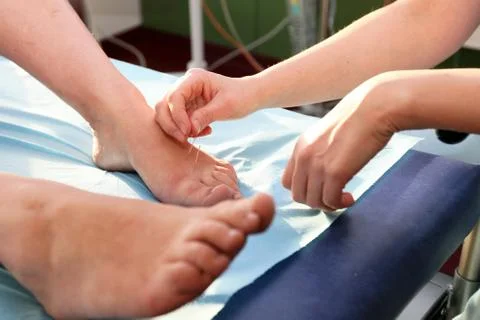 Acupuncture Stock Photos