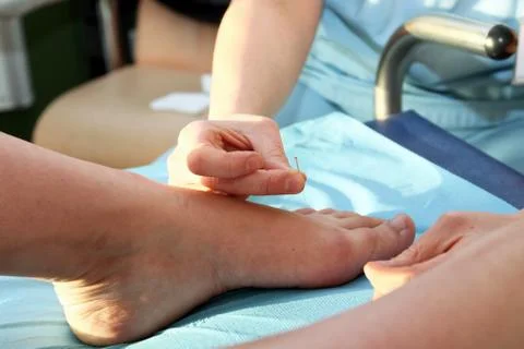 Acupuncture Stock Photos