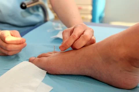 Acupuncture Stock Photos