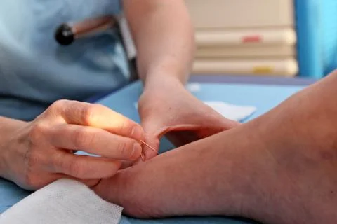 Acupuncture Stock Photos