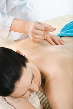 Acupuncture Stock Photos