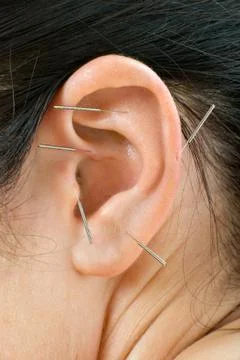 Acupuncture Stock Photos