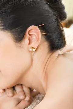 Acupuncture Stock Photos