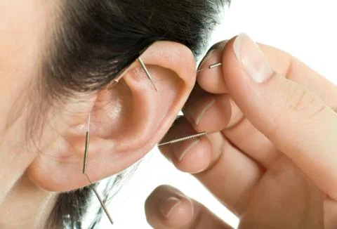 Acupuncture Stock Photos