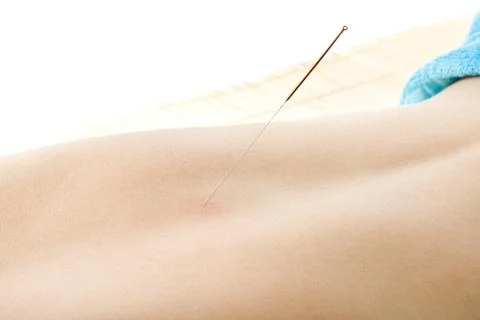 Acupuncture Stock Photos
