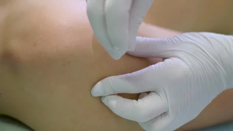 Acupuncture Procedure . Close-up of a man being treated with acupuncture at a cl Stock Footage 253434438