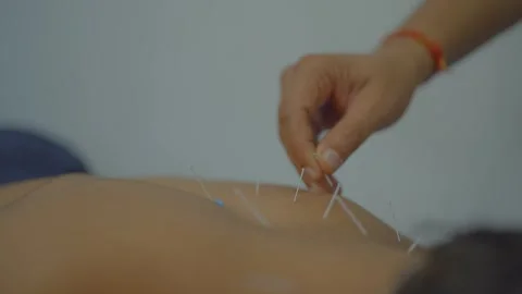 Acupuncture therapy insertion very thin needles through men skin Stock Footage 312256069