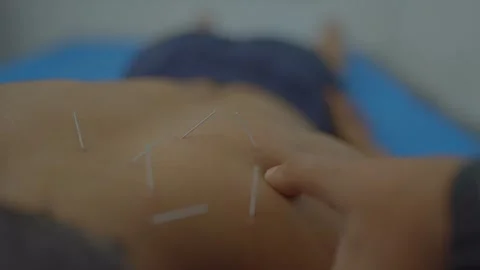 Acupuncture therapy insertion very thin needles through your skin Stock Footage 312256128
