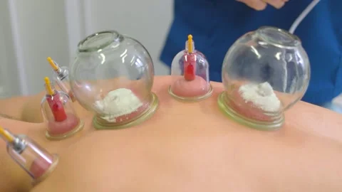 Acupuncture therapy. A man's back is being massaged with a vacuum jar Stock-Footage 253395416