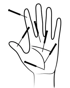 Acupunctured hand Stock Illustration