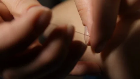 Acupuncture.Dry needling.A close-up of a needle sticking into a patient's Video stock 116561745