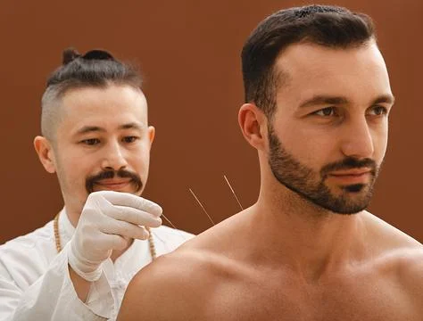 Acupuncturist inserts acupuncture needle into a man shoulder that cures him.. 写真素材
