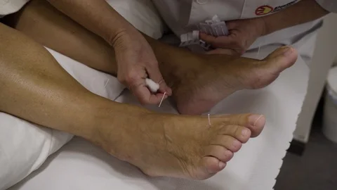 Acupuncturist inserts needles to a patient Stock Footage 99516002