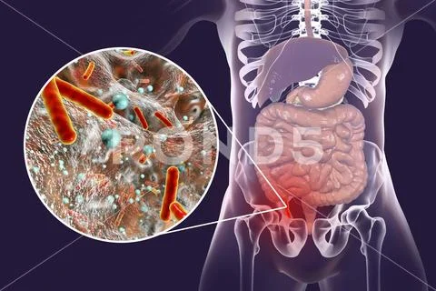 Acute appendicitis illustration Stock Illustration