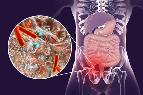 Acute appendicitis illustration Stock Illustration