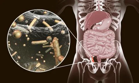 Acute appendicitis illustration Stock Illustration