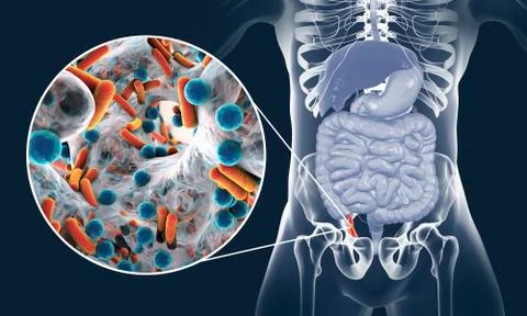 Acute appendicitis illustration Stock Illustration