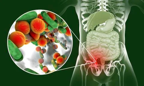 Acute appendicitis illustration Stock Illustration