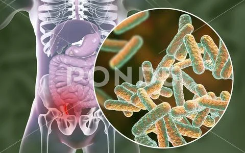 Acute appendicitis illustration Stock Illustration