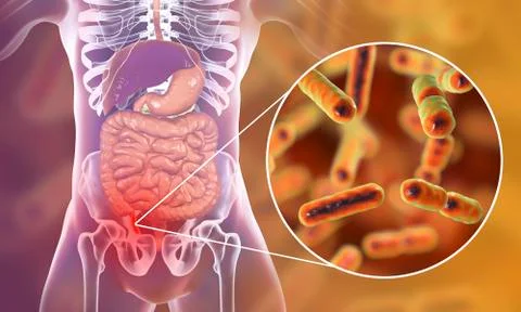 Acute appendicitis illustration Stock Illustration