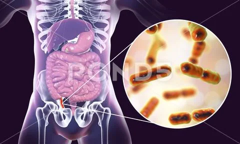 Acute appendicitis illustration Stock Illustration
